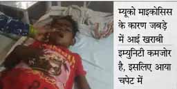अब बच्चों में भी ब्लैक फंगस:जयपुर के जेके लोन अस्पताल में आया पहला केस, 5 साल के मासूम को कोरोना होकर खत्म हो गया, पता ही नहीं चला; अब SMS में बच्चे का ऑपरेशन