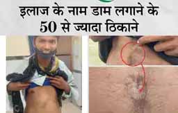 बच्चों को गर्म सरियों से जला रहे भोपे:बीमारी ठीक करने के लिए पेट पर दाग दिया जाता है गर्म सरिया, गांव वालों से पूछा तो&nbsp;शर्ट ऊपर कर बताए&nbsp;घाव; अंधविश्वास में अब तक 6 की मौत