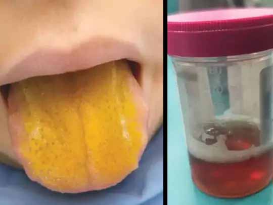 कनाडा में दुर्लभ ऑटोइम्यून डिसऑर्डर का मामला:12 साल के बच्चे की जुबान पीली पड़ी, रोगों से बचाने वाला इम्यून सिस्टम हुआ बेकाबू; जांच में एप्सटीन-बार वायरस की पुष्टि हुई