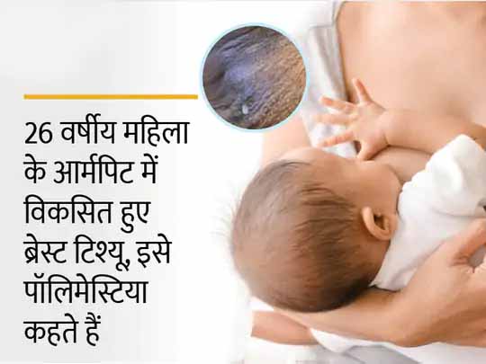 पुर्तगाल का अनोखा मामला:बच्चे को जन्म देने के 2 दिन बाद महिला के आर्मपिट से आने लगा ‘दूध’, जानिए क्या है दुनियाभर की 6% महिलाओं को होने वाली यह बीमारी