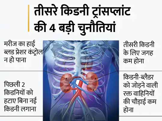 एक मरीज में 5 किडनियां:चेन्नई में 41 साल के एक शख्स का तीसरी बार हुआ किडनी ट्रांसप्लांट, हाई ब्लड प्रेशर के कारण दो बार फेल हुई किडनी, जानिए क्या है पूरा मामला