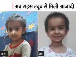 जन्म के 3 साल बाद बच्ची ने खाना खाया:आहार नली में छेद था, ट्यूब से दी जाती थी लिक्विड डाइट; 4 ऑपरेशन के बाद मिली राहत