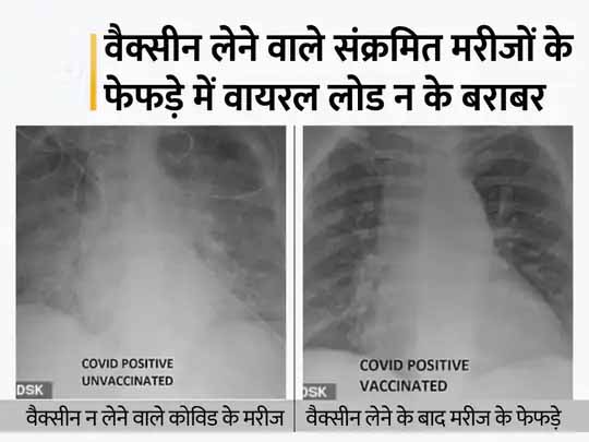वैक्सीन क्यों जरूरी, एक्सरे की 2 तस्वीरों से समझें:वैक्सीन न लेने वाले कोरोना पेशेंट के फेफड़े में दिखे सफेद धब्बे, यही ऑक्सीजन की कमी का कारण; टीका लगवाने वालों में ऐसा नहीं हुआ