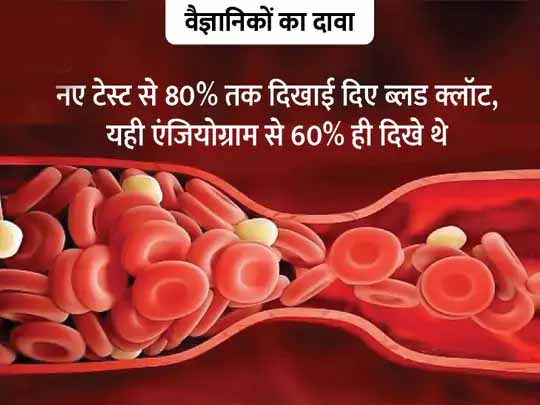 रक्त के थक्के पता लगाने का नया तरीका:वैज्ञानिकों ने डाई का इंजेक्शन लगाकर ब्लॉकेज पता लगाने का नया तरीका खोजा, दावा; यह जांच एंजियोग्राम से भी बेहतर और सुरक्षित