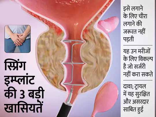 प्रोस्टेट बढ़ने के इलाज का नया विकल्प:स्प्रिंग जैसी डिवाइस से रुक-रुक कर होने वाली यूरिन का इलाज किया जा सकेगा, दावा; ट्रायल में यह डिवाइस सुरक्षित और असरदार साबित हुई
