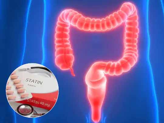राहत देने वाली रिसर्च:कोलेस्ट्रॉल घटाने वाली दवा ‘स्टेटिंस’ से हो सकेगा अल्सरेटिव कोलाइटिस का इलाज, यह आंतों की सूजन घटाने के साथ सर्जरी का खतरा कम करती है
