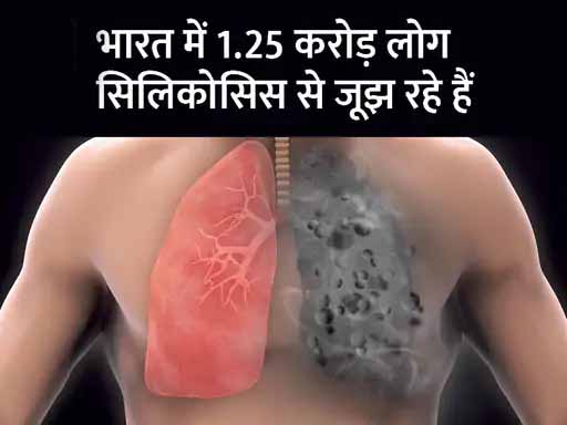 ICMR ने विकसित की सिलीकोसिस का पता लगाने वाली किट