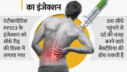 मुंहासों की एंटीबायोटिक दवा से गंभीर पीठ का दर्द भी दूर किया जा सकेगा, यूके के डॉक्टर्स का दावा